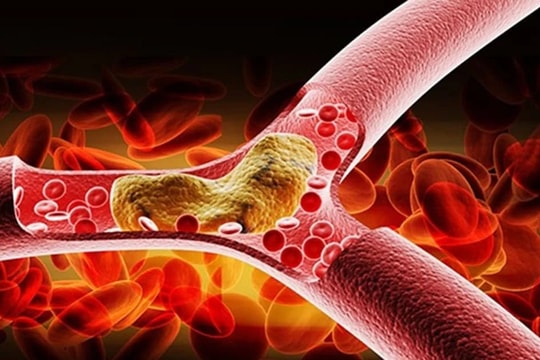 Lý do nào khiến mỡ máu tăng cao vào thời tiết lạnh ?