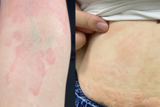 Gia tăng bệnh nhân dị ứng thực phẩm dịp Tết, bác sĩ khuyến cáo cẩn trọng với món ăn "độc lạ"