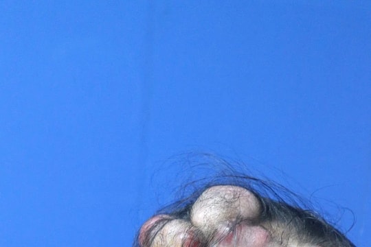 12 giờ phẫu thuật, điều trị thành công ung thư da đầu cho bệnh nhân dân tộc Tày