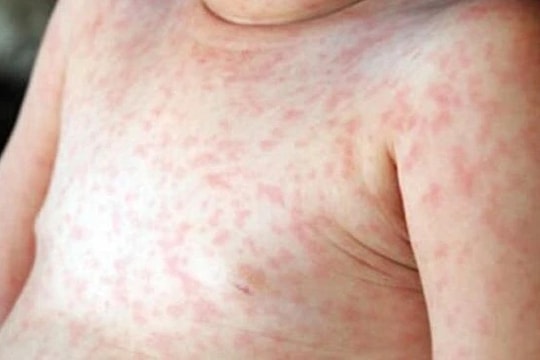 Quảng Nam: Bùng dịch sốt phát ban ở xã Trà Leng, Nam Trà My