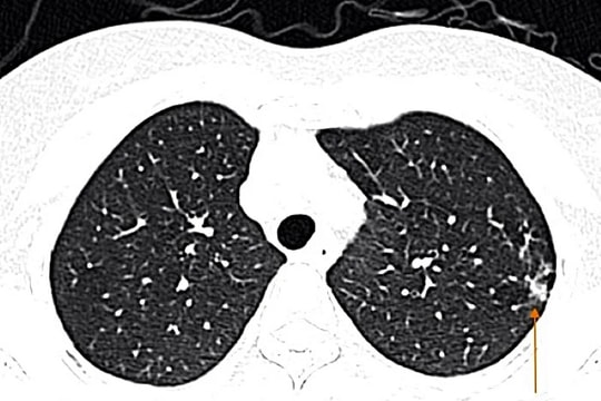 Tự mua thuốc cảm cúm, người phụ nữ nhập viện vì biến chứng viêm phổi: Bác sĩ cảnh báo! 