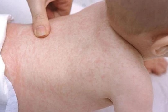 Cha mẹ cần thận trọng với biến chứng của bệnh sởi ở trẻ em