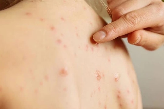 Hà Nội: Tăng hơn 100 trường hợp mắc bệnh sởi