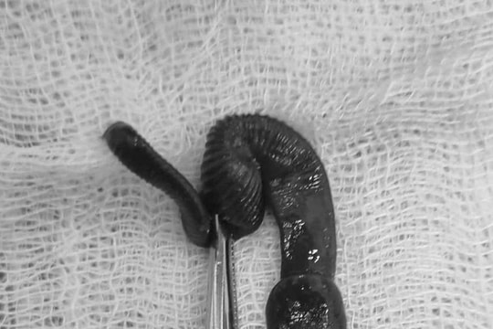 Bác sĩ gắp con vắt dài 8cm trong mũi người đàn ông do uống nước ở khe suối