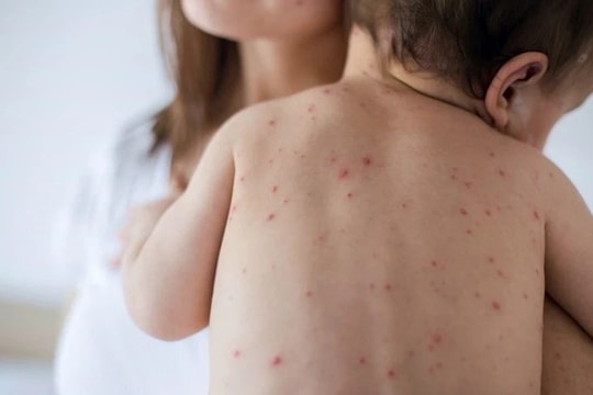 Phòng tránh hữu hiệu các bệnh thường gặp vào mùa Xuân