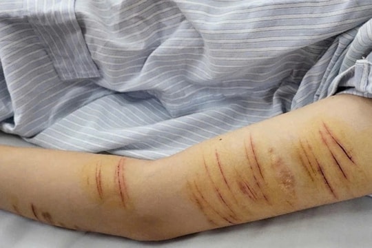 Nữ sinh tự rạch tay để giải tỏa cảm xúc, bác sĩ cảnh báo cha mẹ