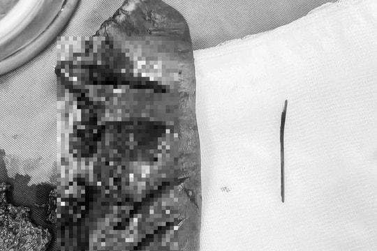  Thói quen ngậm tăm tre sau khi ăn, người đàn ông phải cắt bỏ một phần gan 