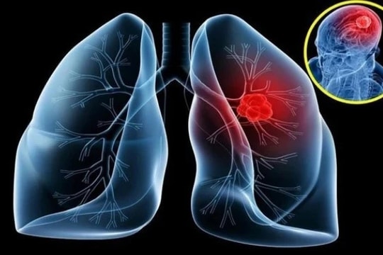 Cảnh báo những triệu chứng có nguy cơ bị ung thư phổi di căn não
