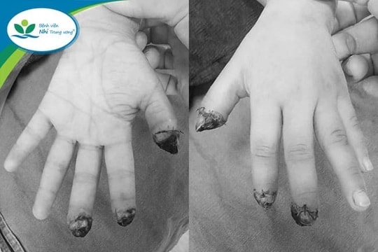 Nối lại 3 ngón tay đứt rời cho bé 5 tuổi sau tai nạn do máy dập nắp cốc tự động