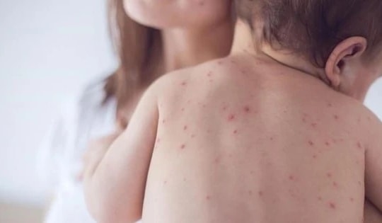 Những cách phòng ngừa bệnh sởi hiệu quả cho trẻ nhỏ