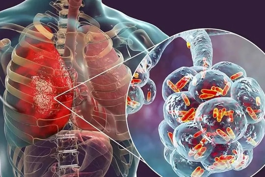 5 hiểu lầm tai hại thường gặp trong ung thư phổi