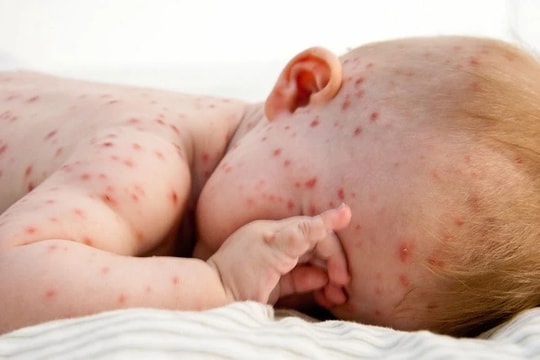 6 cách chăm sóc trẻ bị bệnh sởi tại nhà hiệu quả