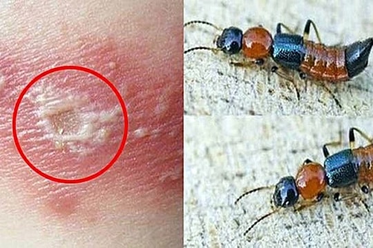 Tổn thương da nghiêm trọng vì đắp kiến ba khoang chữa… ngứa