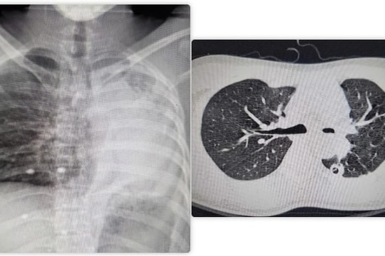 Phẫu thuật thành công hồi sinh lá phổi xẹp hoàn toàn cho nam bệnh nhân