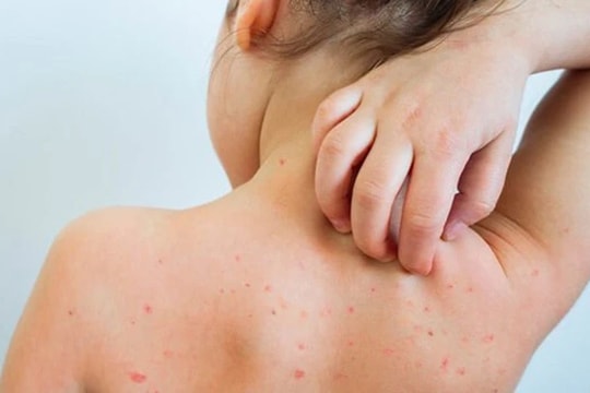 Hà Nội: Kiểm soát nhiễm khuẩn, phòng lây nhiễm chéo bệnh sởi trong các cơ sở y tế