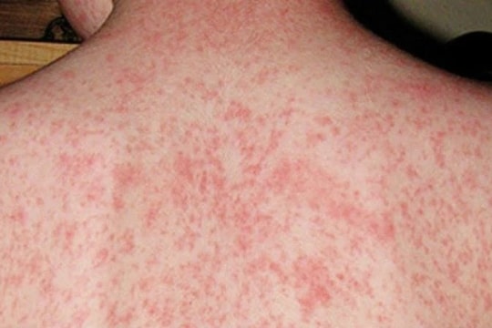 Sởi ủ bệnh trong bao lâu?