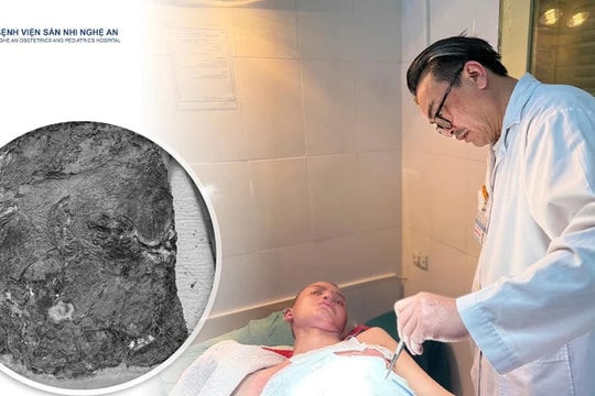 Điều trị bỏng bằng thuốc nam, bệnh nhi 14 tuổi bị nhiễm trùng nặng 