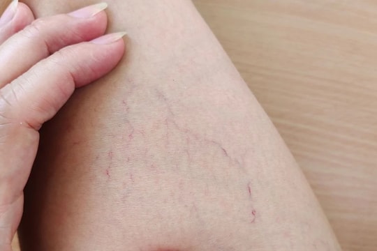 Suy giãn tĩnh mạch là căn bệnh nguy hiểm người trưởng thành phải đối mặt