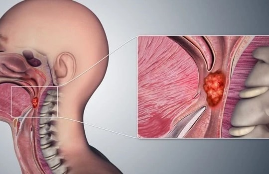 Bác sĩ Bệnh viện K chỉ ra dấu hiệu nhận biết ung thư vòm hầu