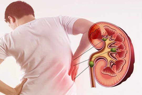 Hội chứng thận hư tái phát vì tự ý bỏ thuốc, bác sĩ cảnh báo