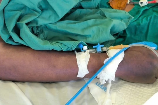 Ăn món khoái khẩu lòng lợn, người đàn ông nguy kịch do mắc liên cầu khuẩn lợn