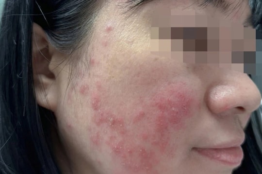 Tin kem trị mụn “thảo dược thiên nhiên” trên TikTok, nữ sinh nổi mụn nước khắp mặt