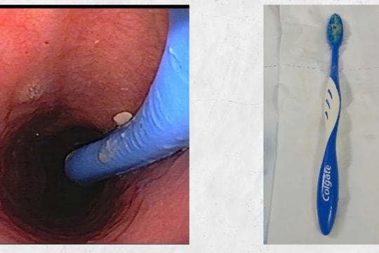 Hy hữu: Người phụ nữ vô tình nuốt bàn chải đánh răng dài 17cm vào thực quản