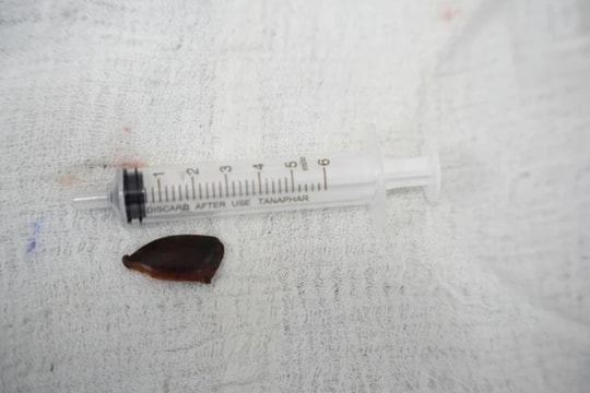 Ho kéo dài suốt tháng, cụ bà phát hiện hạt hồng xiêm nằm sâu trong phế quản