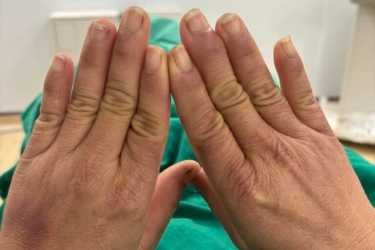 Căn bệnh lạ khiến người phụ nữ đau đớn mỗi khi chạm tay vào nước