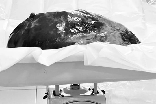 Phẫu thuật thành công người bệnh có khối u trung thất khổng lồ 3,6kg hiếm gặp