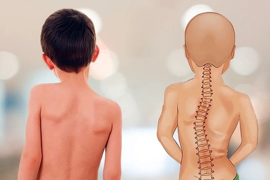 Bệnh viện Hữu nghị Việt Đức khám, tư vấn miễn phí bệnh gù vẹo cột sống