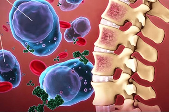  Đa u tủy xương một bệnh máu ác tính