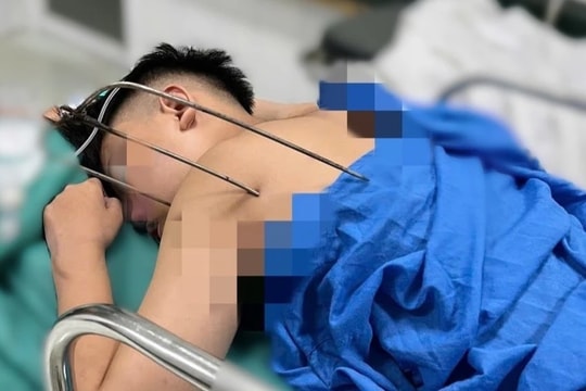 Cứu sống nam thanh niên 17 tuổi bị dị vật kim loại xuyên thấu tim