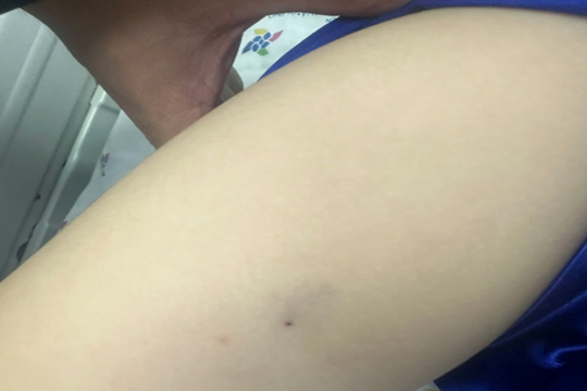 Bé trai sốc phản vệ do ong ruồi đốt