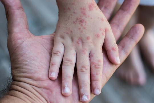 Hà Nội: Ghi nhận 1 trường hợp đầu tiên mắc Rubella trong năm 2025