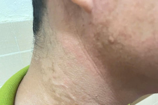 Thêm 1 trường hợp mắc bệnh giun rồng tại Phú Thọ