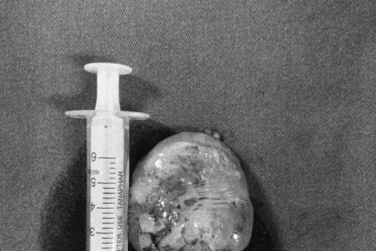 Đi khám zona thần kinh, người phụ nữ bất ngờ phát hiện khối u khổng lồ trong tim