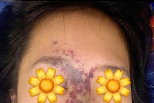 Biến chứng nặng vì phẫu thuật thẩm mỹ tại các cơ sở tư nhân không đảm bảo an toàn