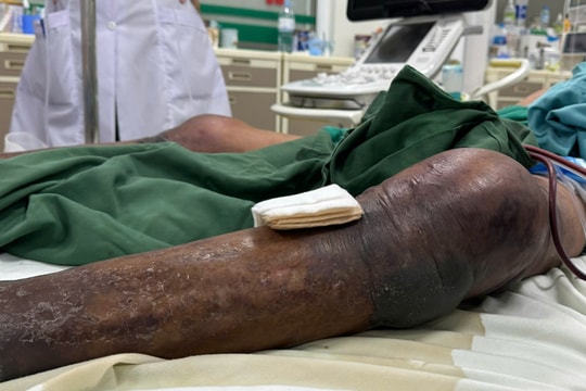 Bị gai đâm tưởng như vô hại, người đàn ông nguy cơ hoại tử toàn thân