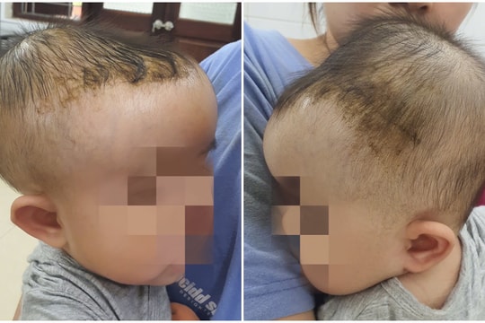 Trẻ 7 tháng tuổi bị tụ máu đầu sau cú ngã tưởng chừng như vô hại