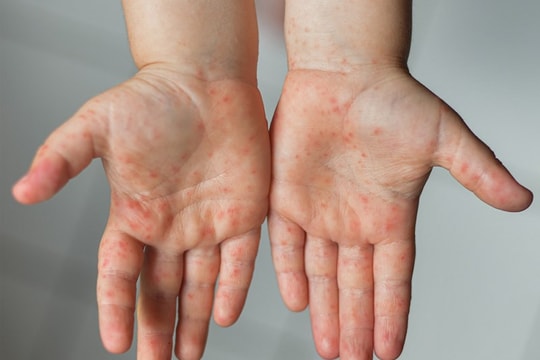 Cảnh báo tay chân miệng bùng phát: Bộ Y tế khuyến cáo “3 sạch” để phòng bệnh