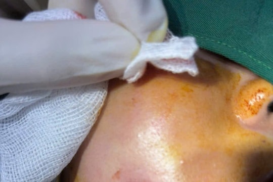 Người phụ nữ bị nhiễm trùng sau thẩm mỹ má lúm đồng tiền