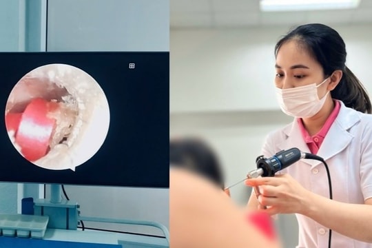 Bé gái 6 tuổi suýt thủng màng nhĩ vì một sợi dây buộc tóc