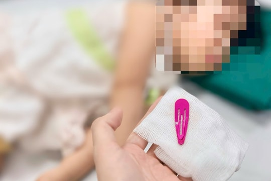 Phụ huynh hoảng hốt khi bé 21 tháng tuổi nuốt kẹp tóc dài 5cm vào sâu trong dạ dày