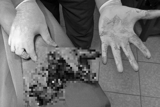 Dập nát bàn tay trái vì dùng điện thoại khi sạc pin