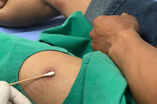 Thói quen ăn đồ sống, người đàn ông nhiễm sán dây chó, sán dây lợn và giun đũa chó mèo