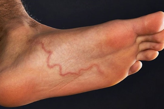 Bệnh giun rồng tái xuất : Cách nhận biết và phòng ngừa hiệu quả