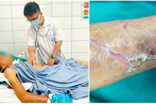 Nguy hiểm uốn ván từ vết thương ngoài da do dị vật đâm