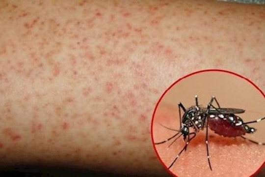 Trẻ em dễ mắc sốt xuất huyết khi vào mùa, cha mẹ cần làm gì?