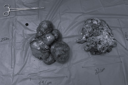 Phát hiện bụng to bất thường, người phụ nữ 37 tuổi mang khối u nặng như em bé sơ sinh